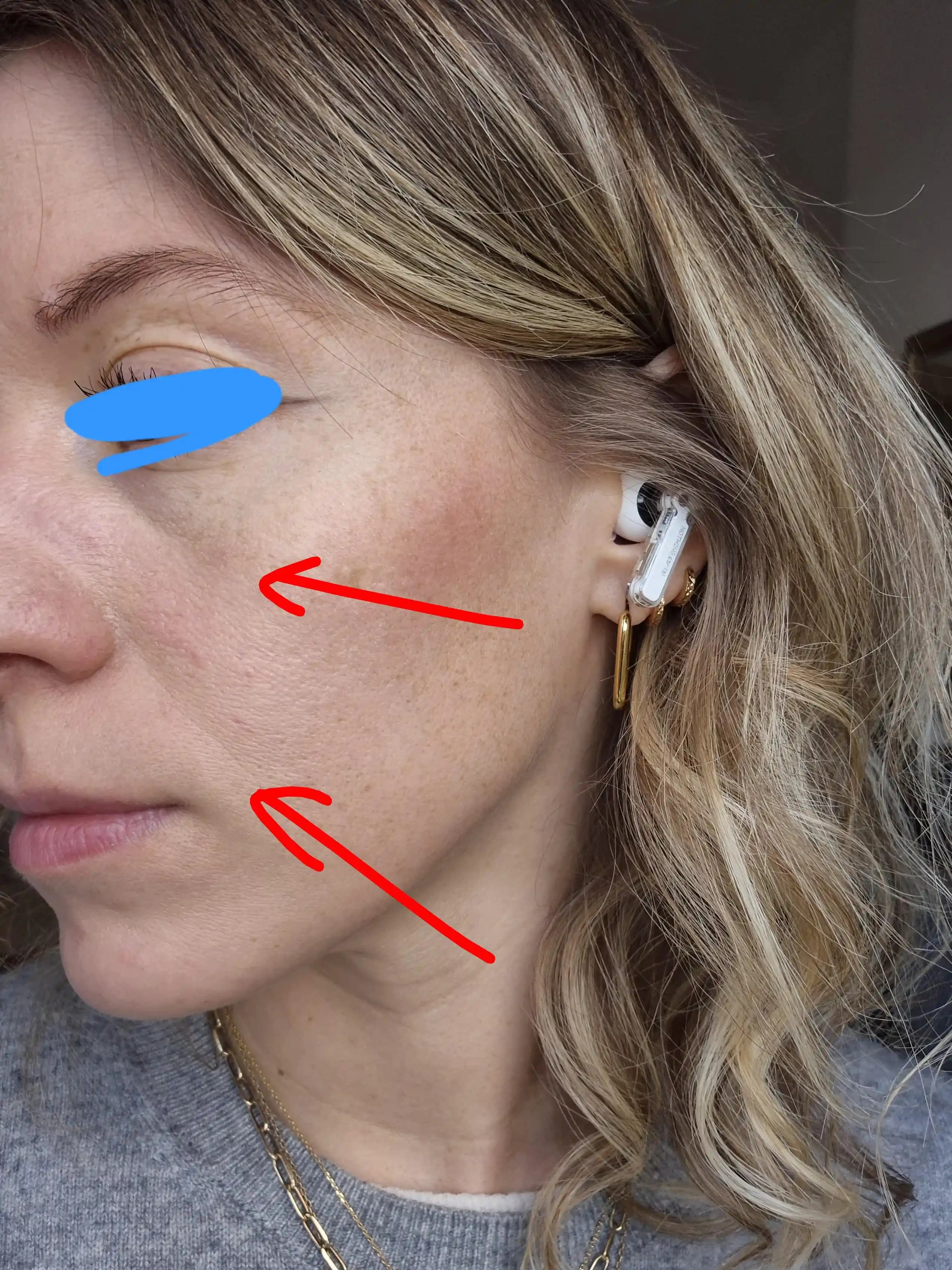 30'lu Yaşlarda Göz Altı ve Nazolabial Çizgilerin Nedenleri ve Etkili Çözümleri