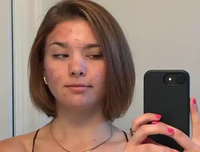 Akne Tedavisinde 2.5 Ayda Kaydedilen İlerleme ve Bütünsel Yaklaşımlar