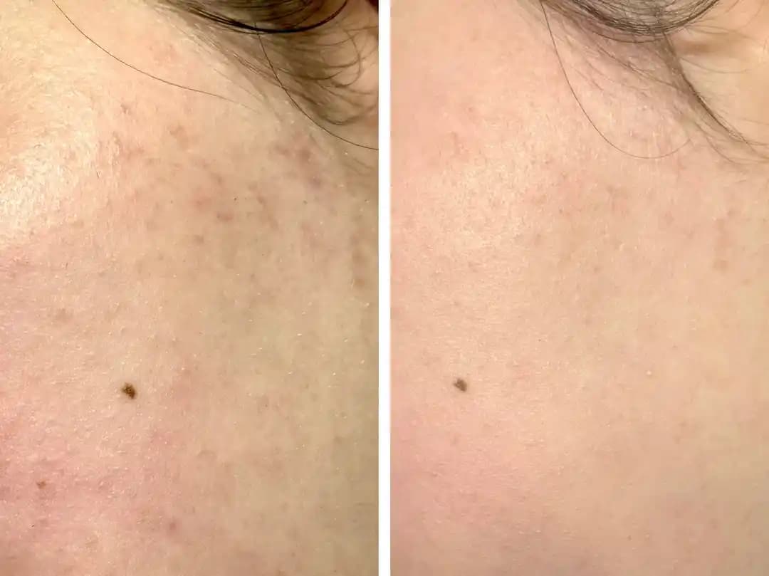 Azelaik Asit ile Cilt Dokusu ve Hiperpigmentasyon Tedavisinde 2 Haftalık Kullanım Sonuçları