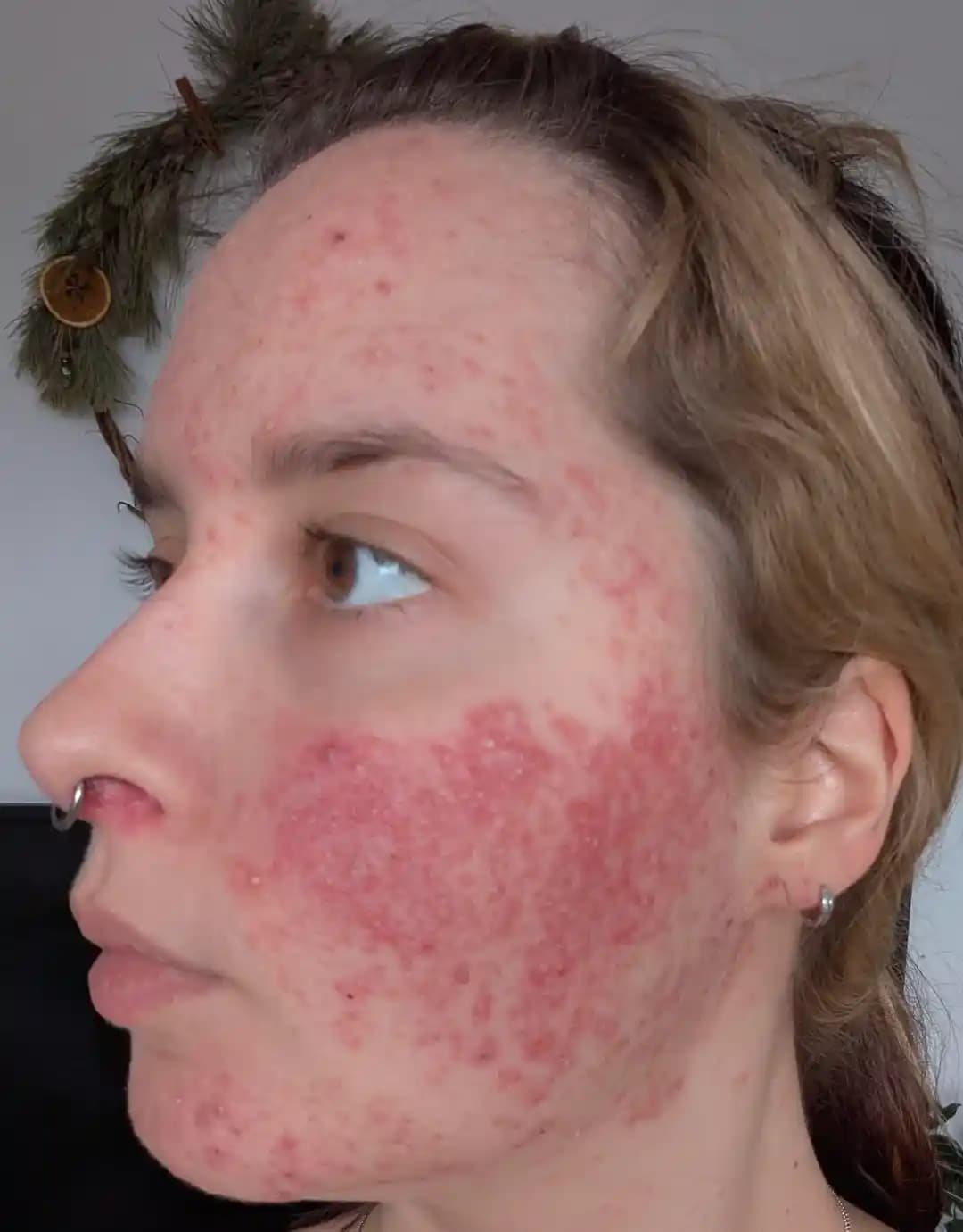 Cilt Sağlığında İyileşme Süreci: Sabır, Doğru Bakım ve Bağırsak Sağlığının Rolü