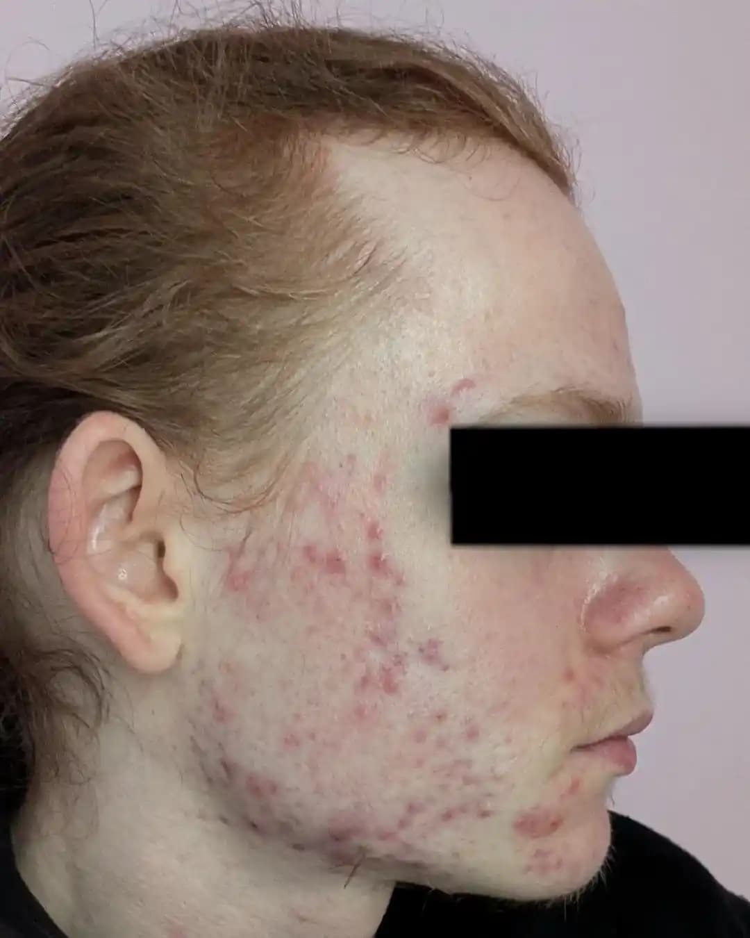 İzotretinoin Reçete Edilmeyen Akne Tedavisinde Alternatif Yöntemler ve Cilt Bakımı