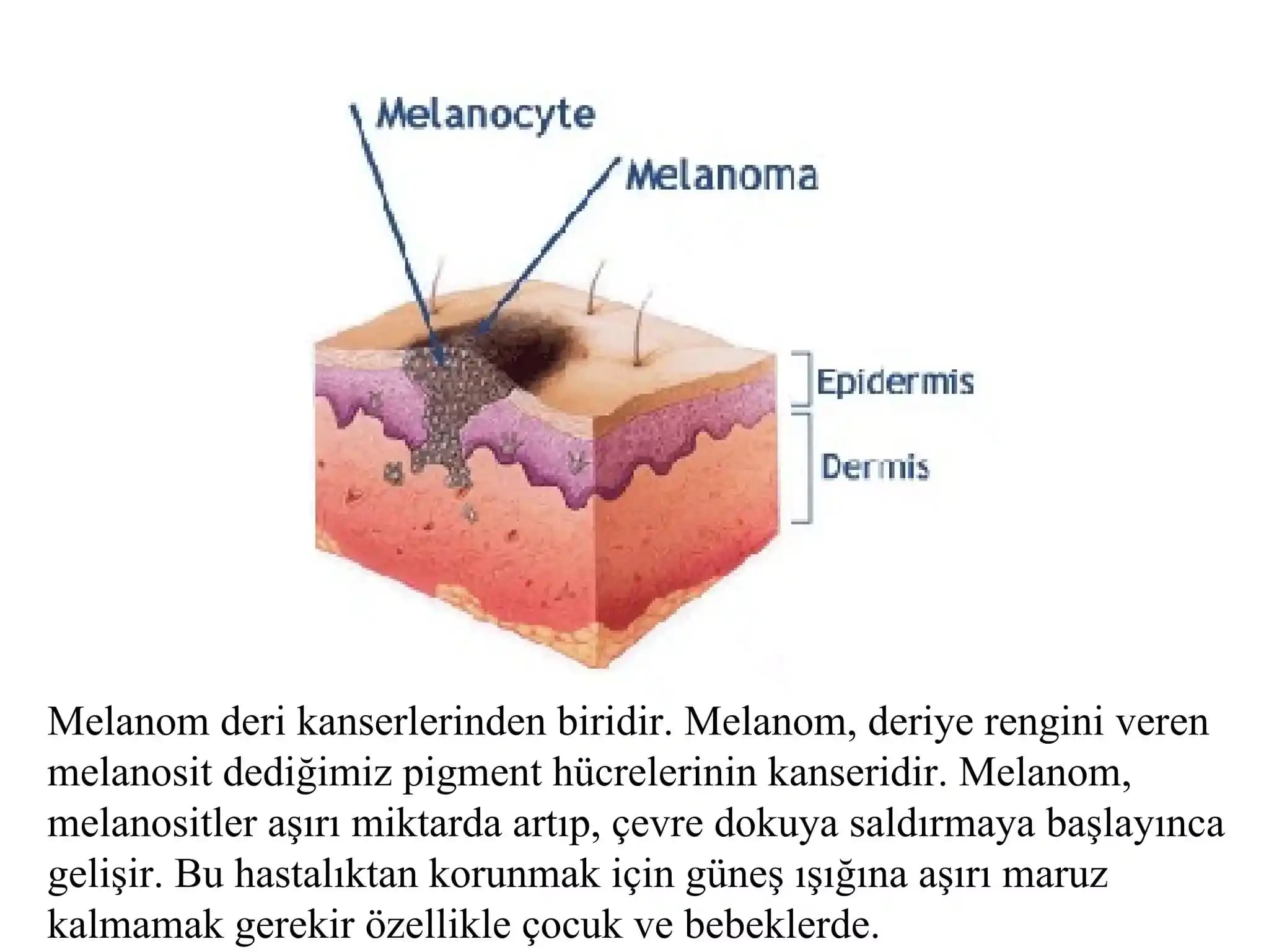 Melanom Geçmişi Olanlar İçin Ofiste UV Koruması ve Uygulanabilir Çözümler