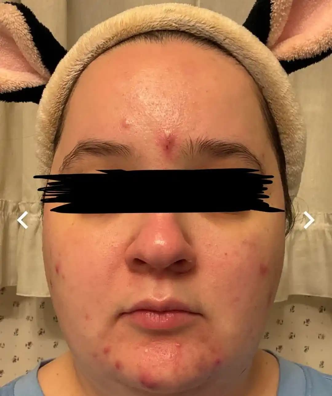 Niasinamidin Kistik Akneye Yol Açması ve Ciltteki Farklı Tepkiler Üzerine İnceleme