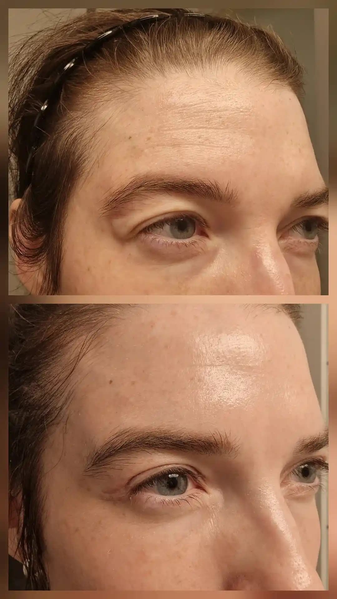 Norveç'te Kış Aylarında Güneş Koruyucu ve Tretinoin Kullanımı ile Cilt Bakım Rutini