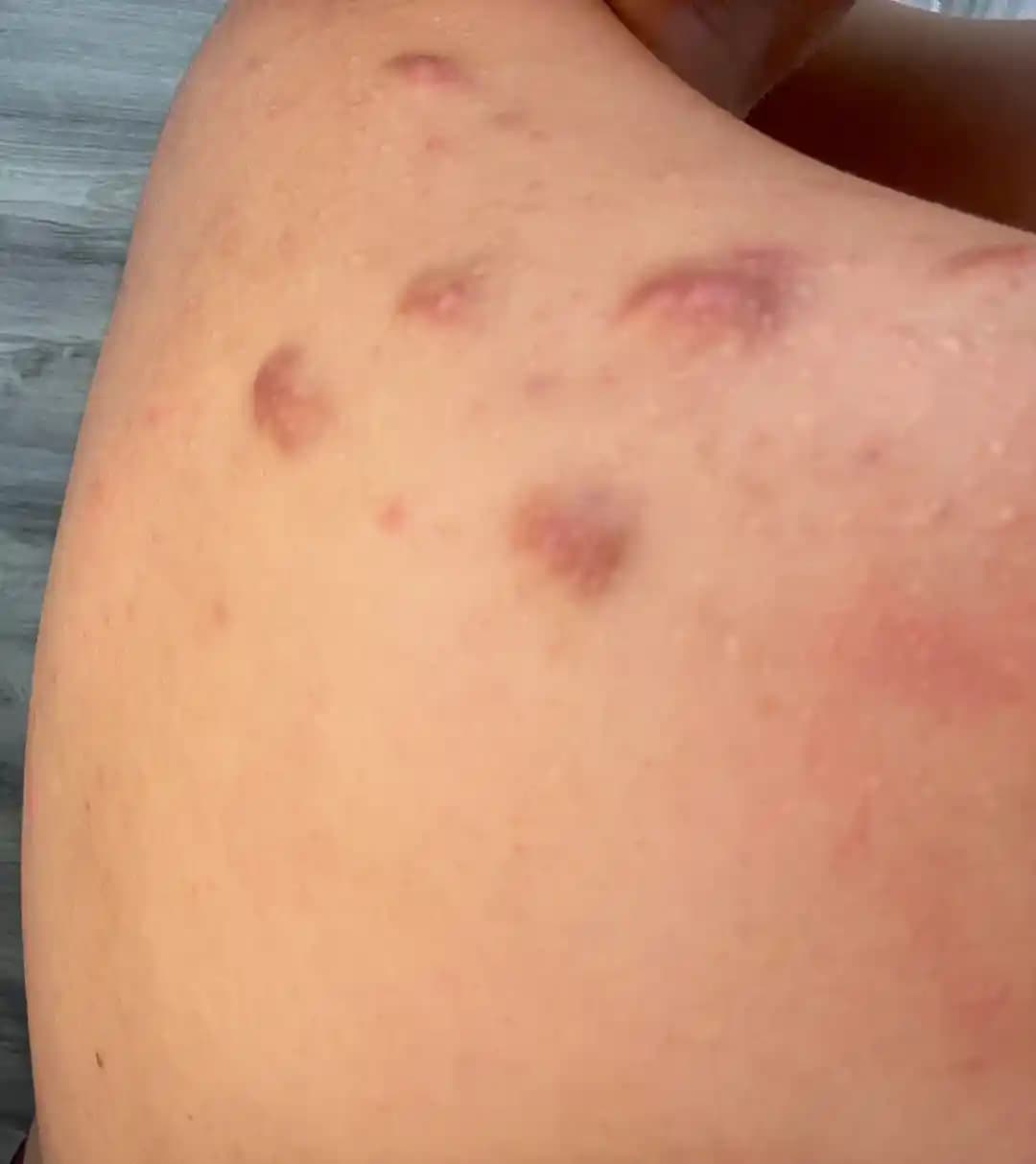 Sırt Aknesi ve Keloid Oluşumu: Klinik Özellikler, Tedavi Yöntemleri ve Uzman Görüşleri