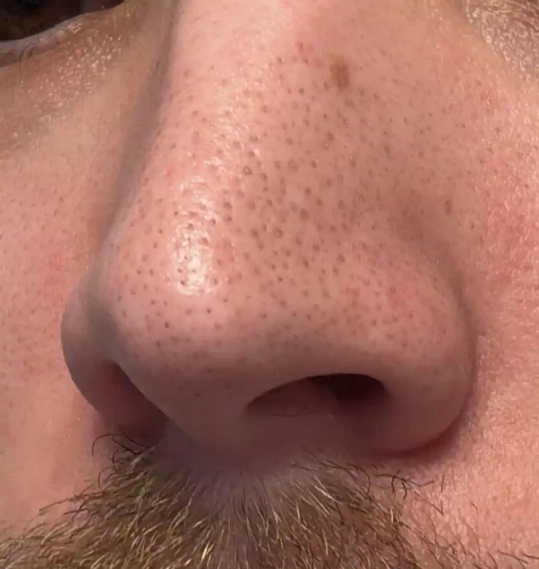 Yüzdeki Siyah Noktalar ve Sebum Filamentleri: Tanı ve Etkili Tedavi Yöntemleri