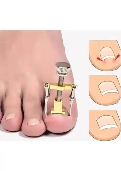 Greathings Profesyonel Batık Tırnağı Düzeltme Aparatı ile Etkili ve Güvenli Tırnak Bakımı