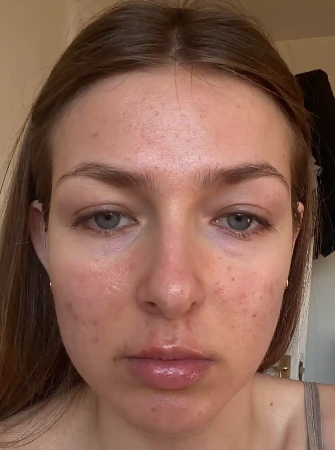 Adet Döngüsü Öncesi Cilt Değişiklikleri ve Etkili Yönetim Yöntemleri