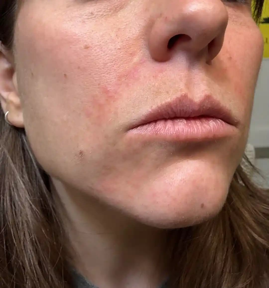Ağız Çevresinde Perioral Dermatit: Nedenleri, Belirtileri ve Etkili Tedavi Yöntemleri