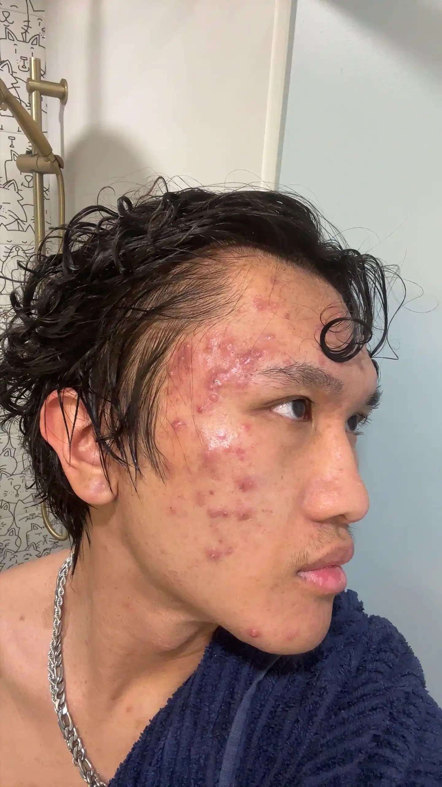 Akne Ağrısını Azaltmak İçin Dermatolojik Tedavi ve Etkili Bakım Yöntemleri