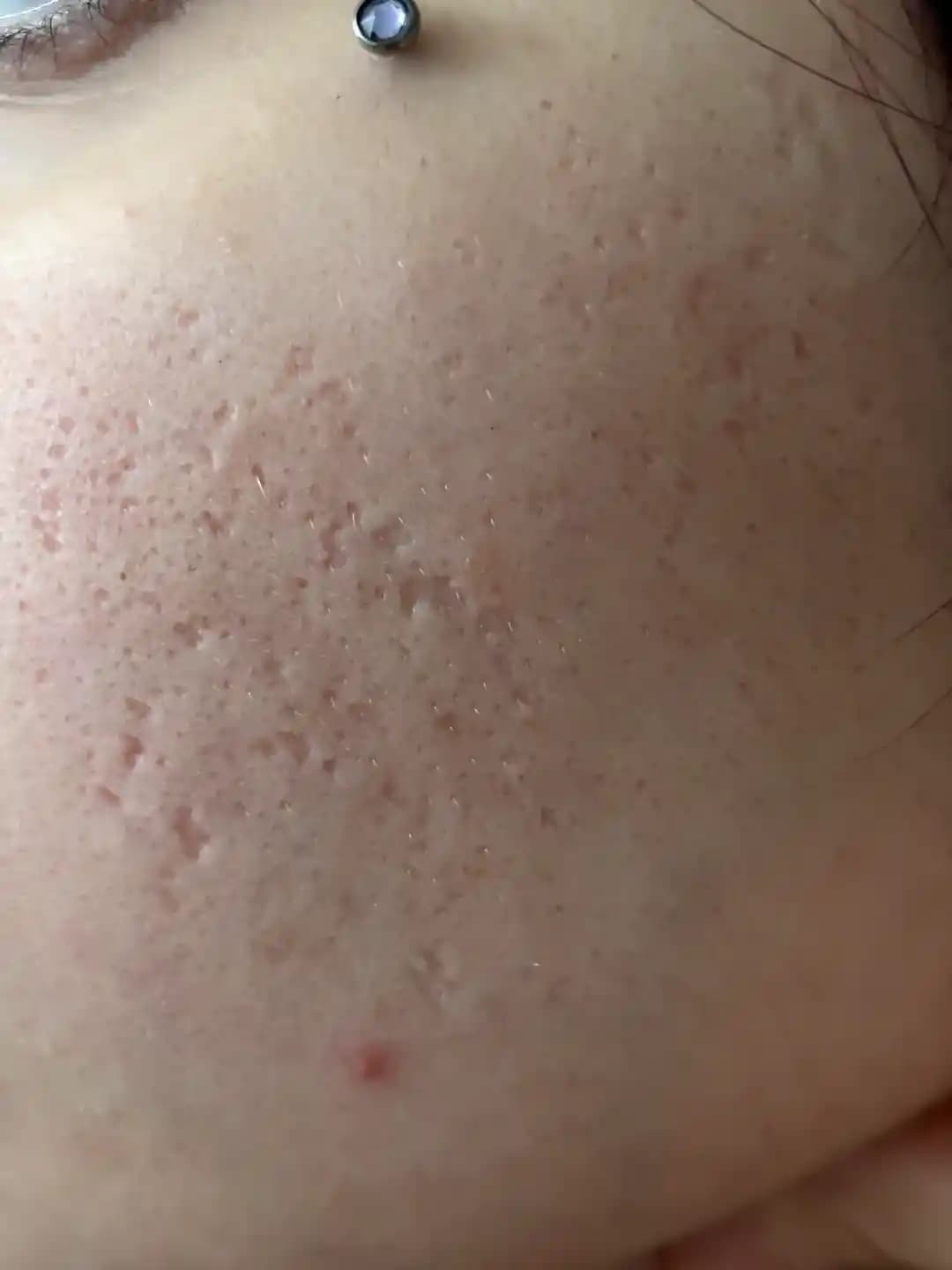 Derin Akne İzleri İçin Subcision, TCA CROSS, Mikroneedling ve Lazer Tedavileri