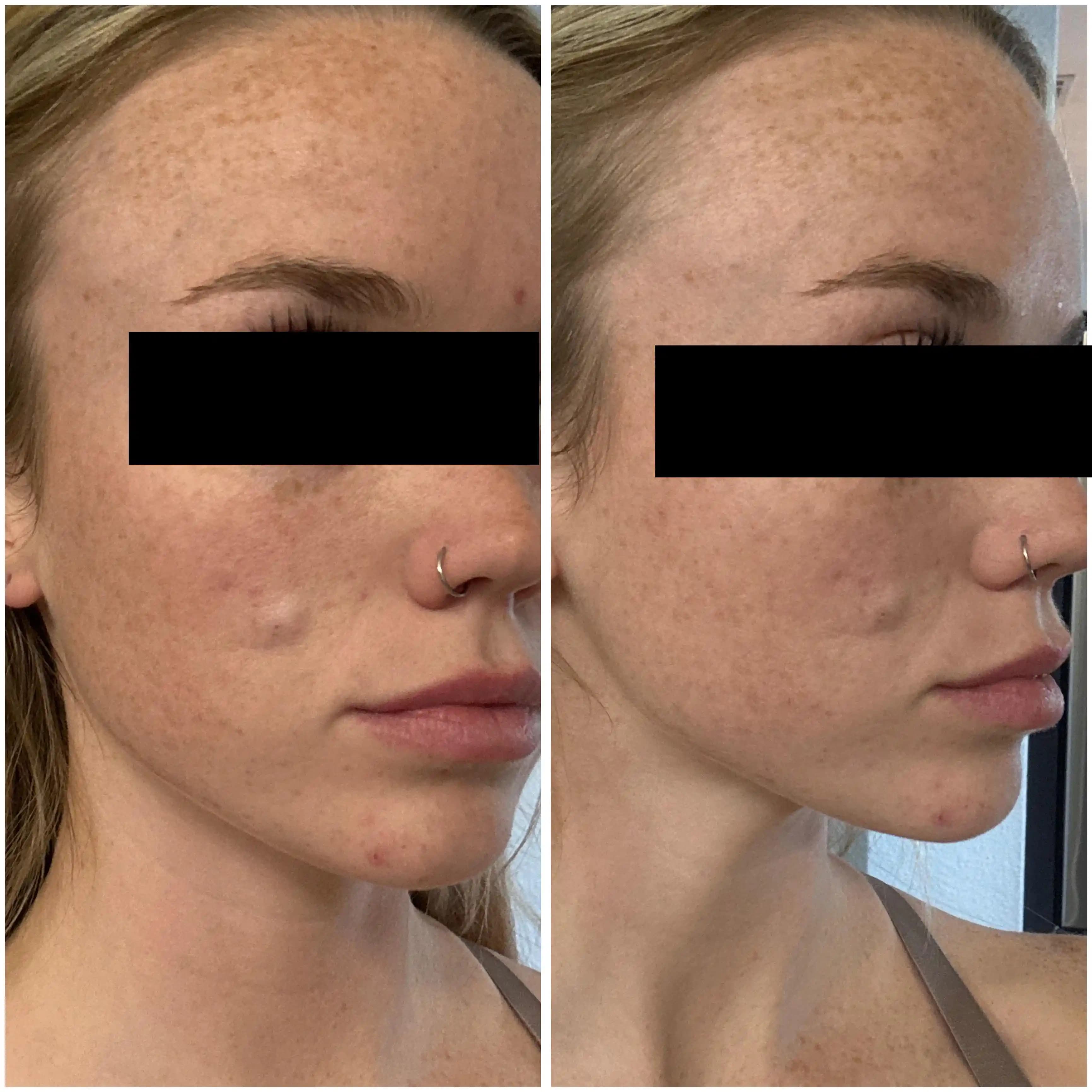 Düğün Öncesi Sebase Kist Ameliyatı ve İyileşme Sürecinde Dikkat Edilmesi Gerekenler