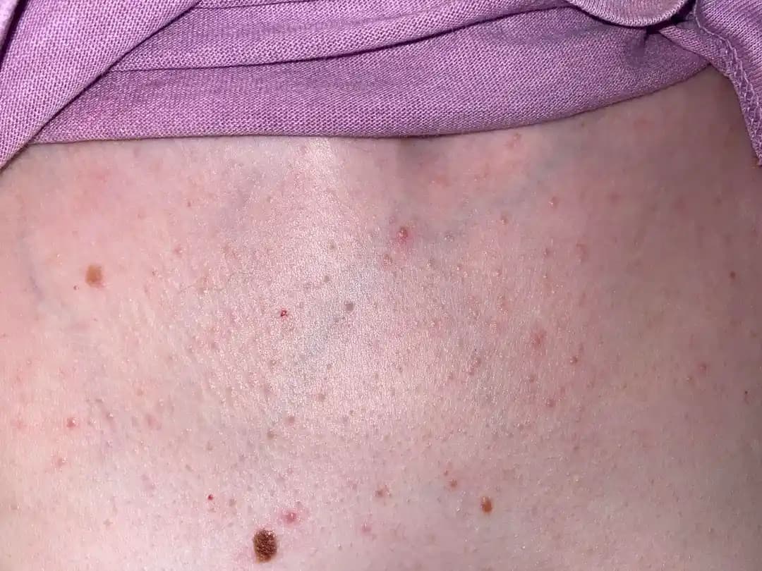 Göğüs Bölgesinde Akne ve Cilt Lekeleri: Nedenleri, Tedavi Yöntemleri ve Bakım Önerileri