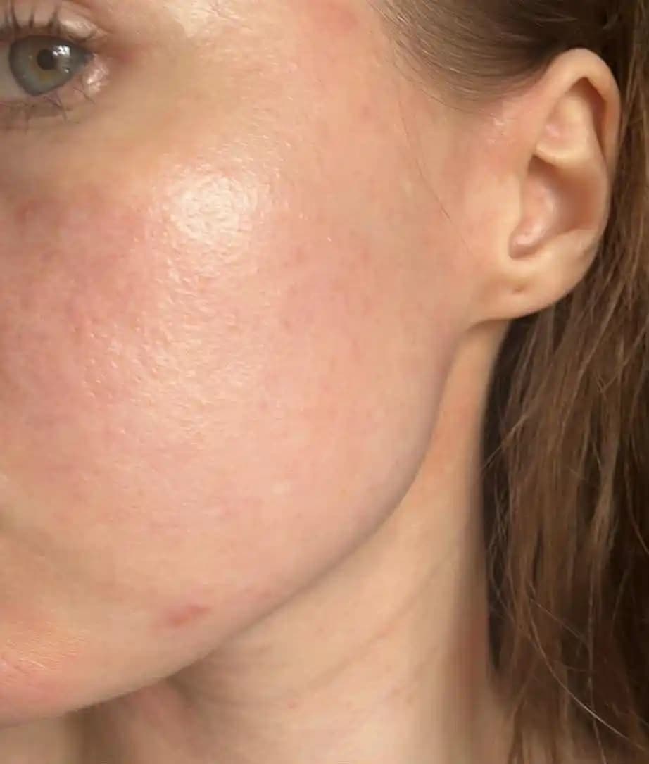 Hassas Ciltlerde Küçük Tümseklikler ve Cilt Bariyeri Sorunlarında Salisilik ve Glikolik Asit Kullanımı