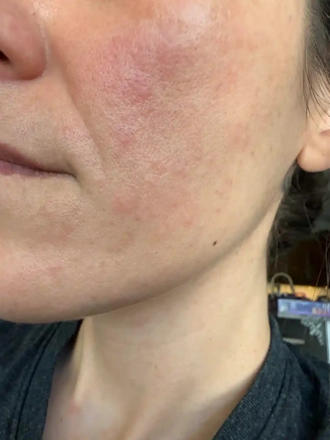 Hassas Ciltlerde Reaksiyon Yönetimi ve Etkili Cilt Bakım Rutini Önerileri