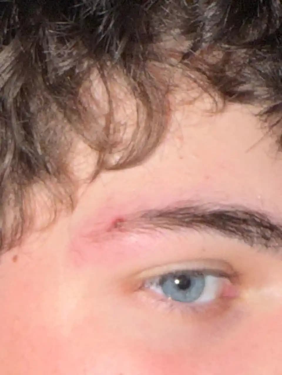 Kaş Bölgesindeki Sivilceyi Gizlemek ve İyileştirmek İçin Etkili Yöntemler