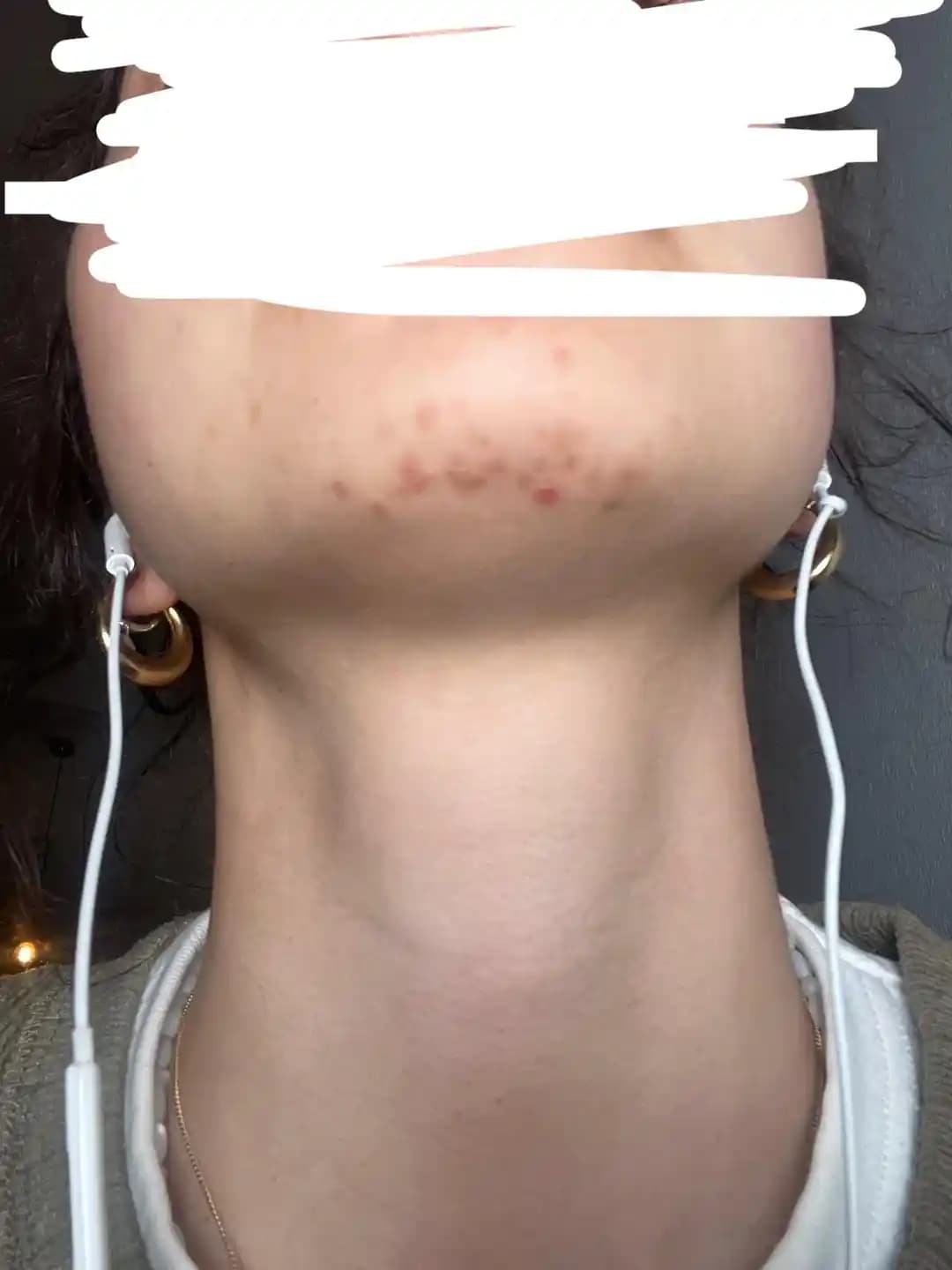 PCOS Kaynaklı Çene Tüyleri ve Cilt Sorunları: Tedavi ve Bakım Yöntemleri