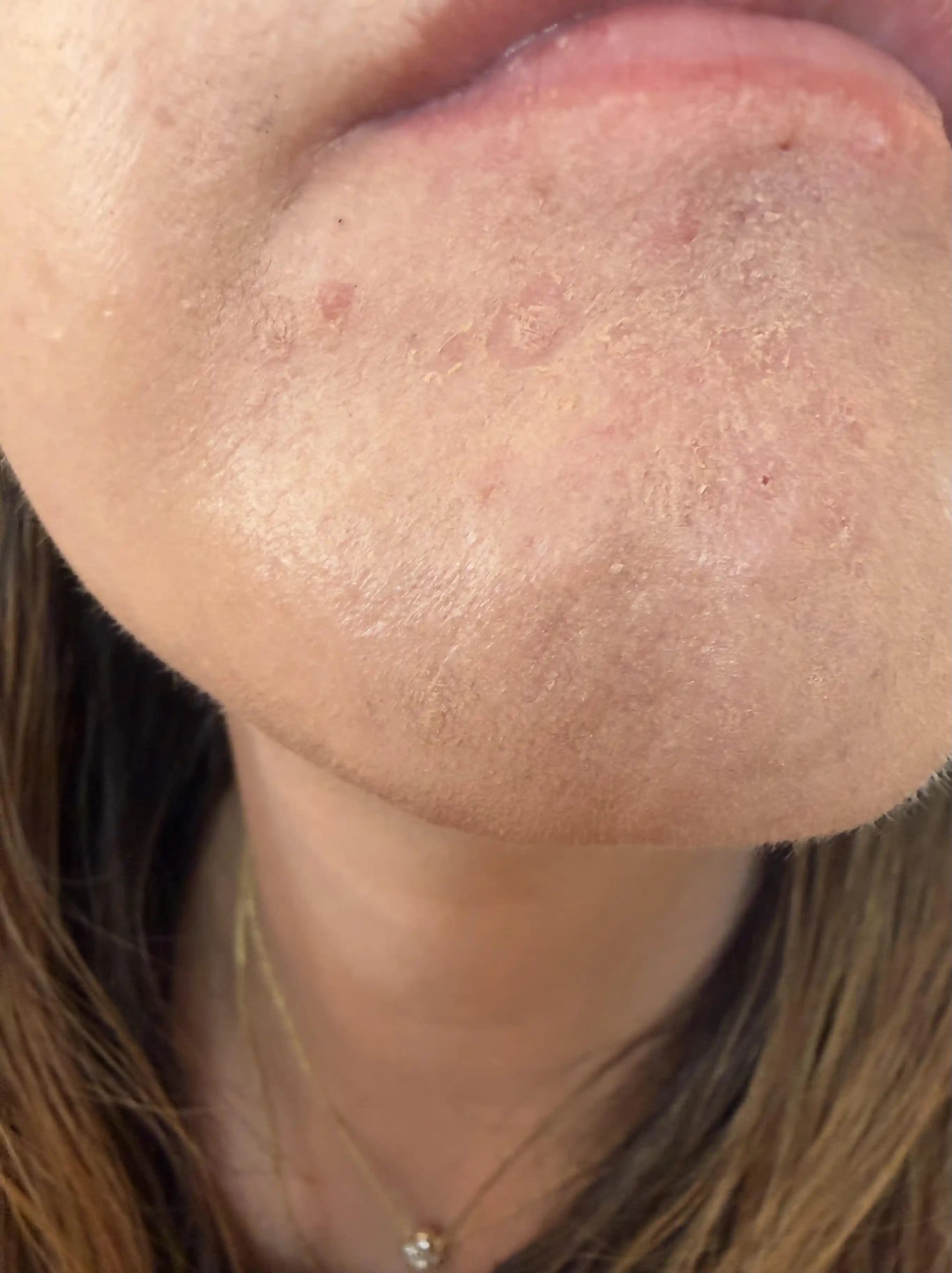 Tretinoin Kullanımında Fondötenin Kuruyup Pul Pul Olmasının Nedenleri ve Çözüm Yöntemleri