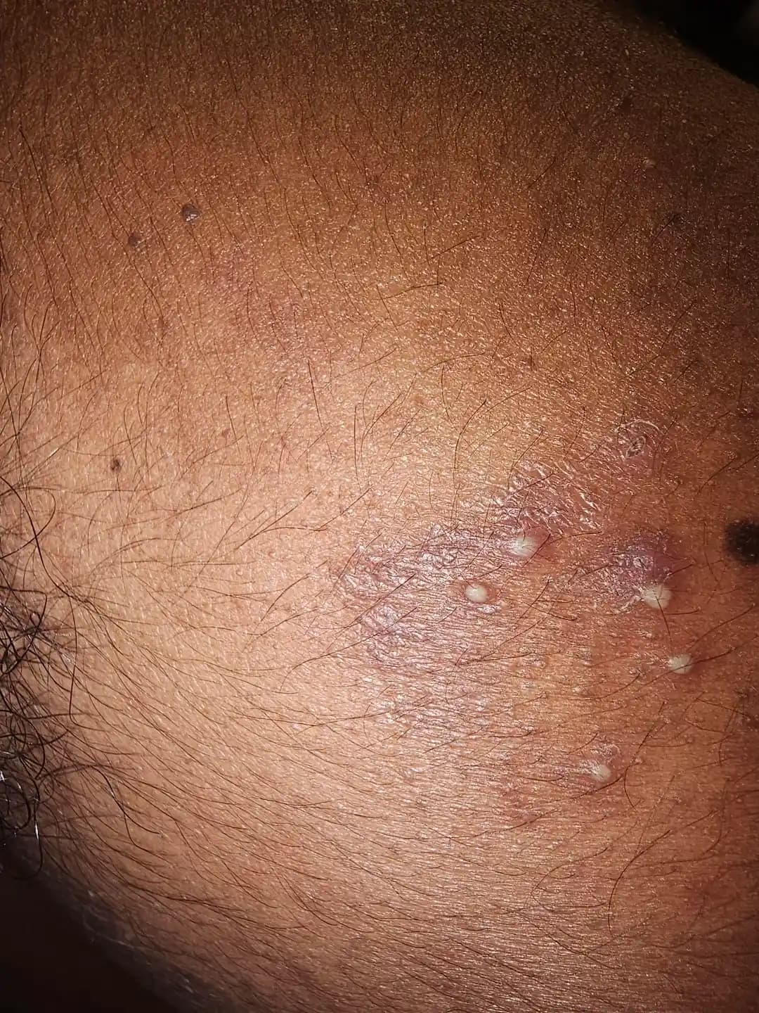 Yüzde Belirli Bölgedeki Sivilce ve Hiperpigmentasyonun Nedenleri ve Etkili Çözümleri