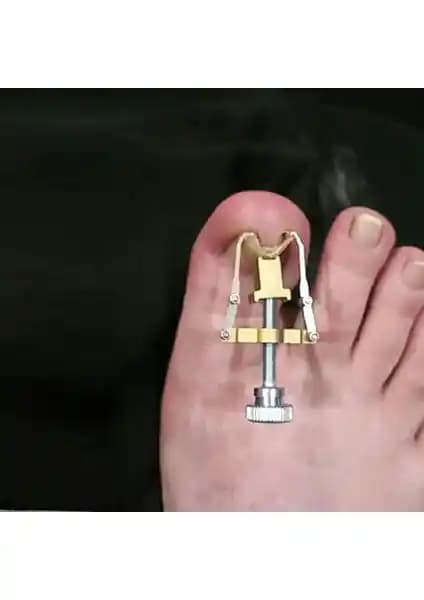 Batık Tırnak Düzeltme Aleti: Güvenli ve Pratik Çözüm ile Tırnak Sorunlarını Hafifletin