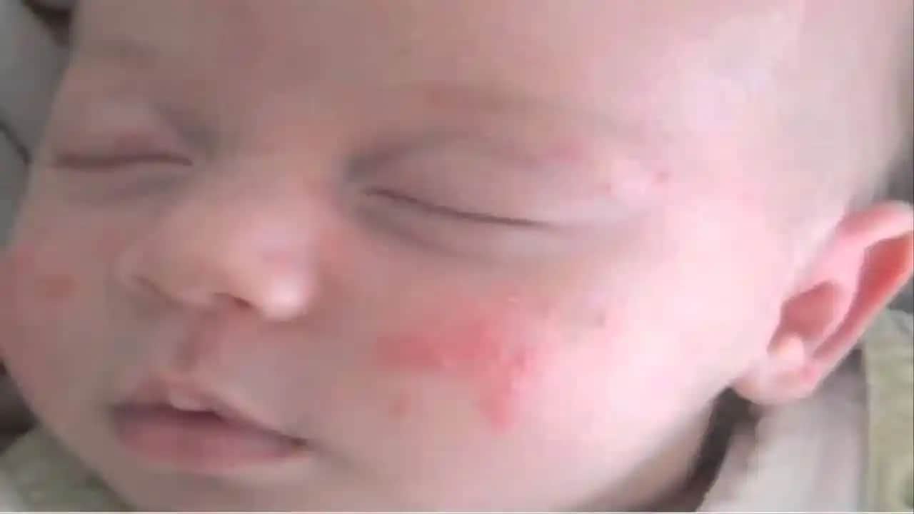 1 Yaşındaki Bebeklerde Sivilce Nedenleri ve Doğal Bakım Yöntemleri