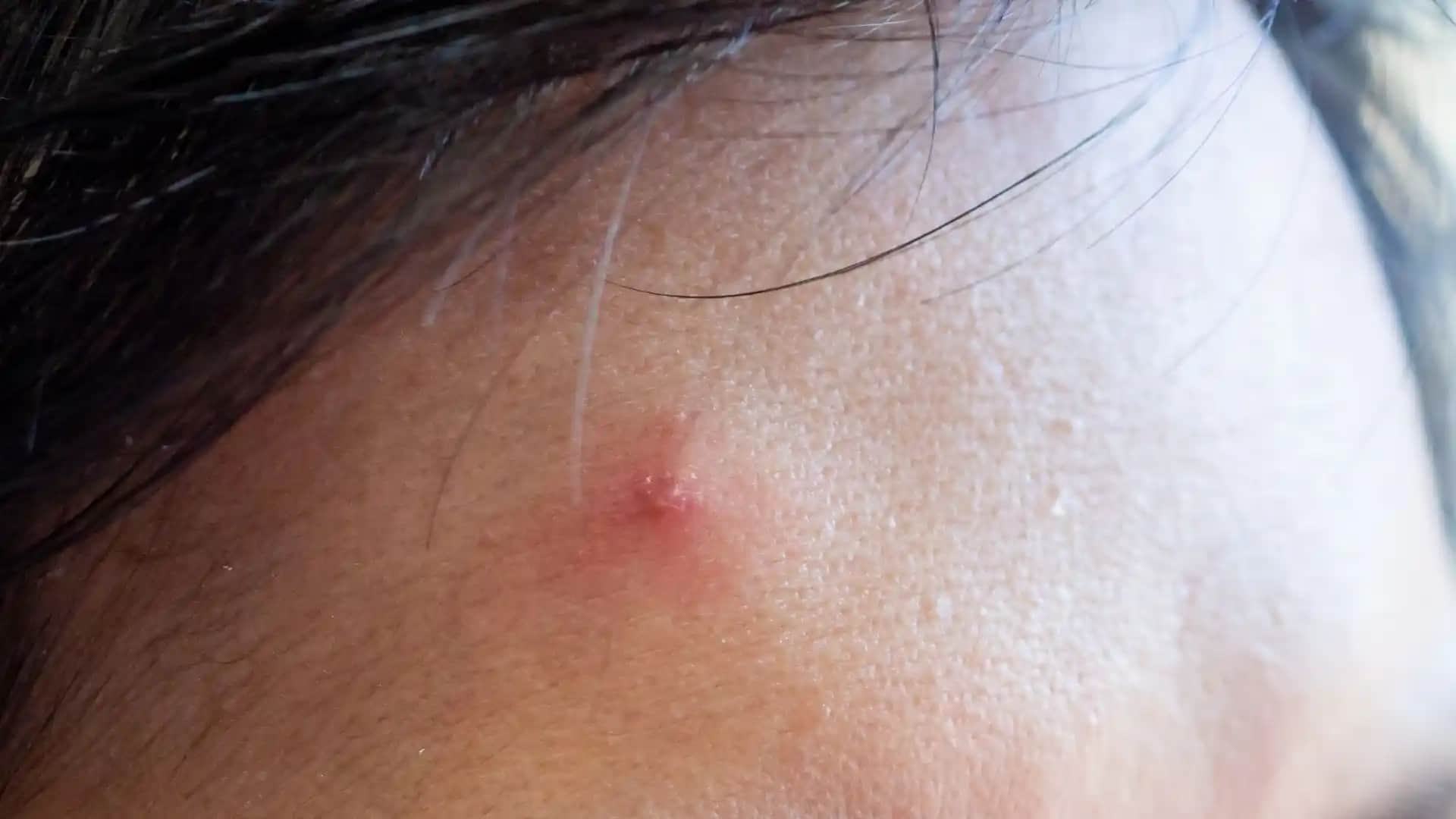 14 Yaşında Sivilceleri Önleme ve Tedavi Yöntemleri Cilt Sağlığı Rehberi