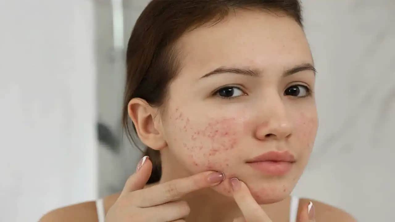 15 Yaş Sivilceleri Nasıl Geçer ve Ergenlikte Cilt Sağlığını Koruma Yöntemleri