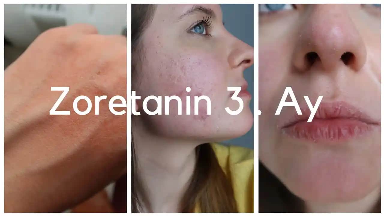 3 Yaş Sivilcesi Nedenleri ve Çocuklar İçin Uygun Cilt Bakım Yöntemleri