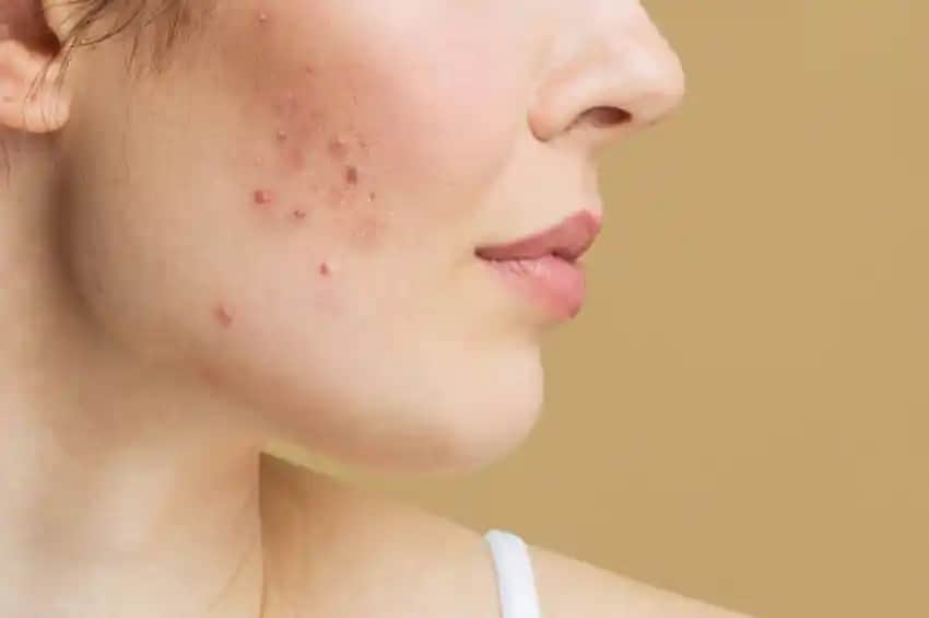 4 aydan uzun süren sivilceler ve etkili çözüm yolları hakkında kapsamlı rehber