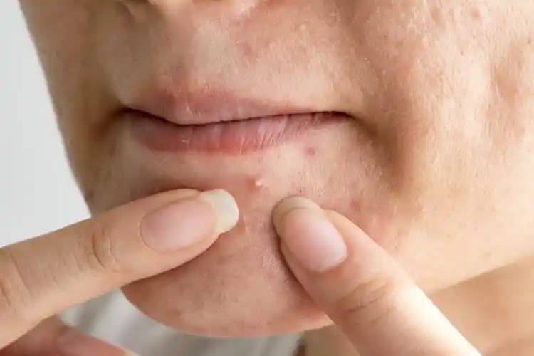 40 Yaşında Sivilce Nedenleri ve Etkili Önleme Yöntemleri