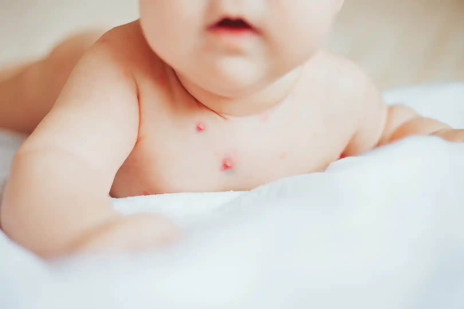 5 Yaşındaki Çocuklarda Yüz Sivilcesi Nedenleri ve Uygun Bakım Yöntemleri