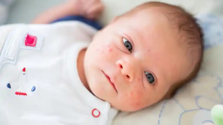 6 Yaşındaki Çocukların Yüzünde Sivilce Nedenleri ve Etkili Çözüm Yöntemleri