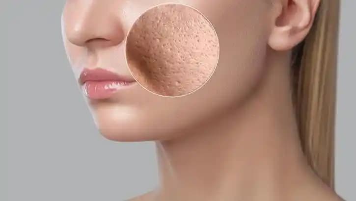 Açık Gözenekli Cilt İçin Etkili Kozmetik Yaklaşımlar ve Doğru Uygulama Yöntemleri