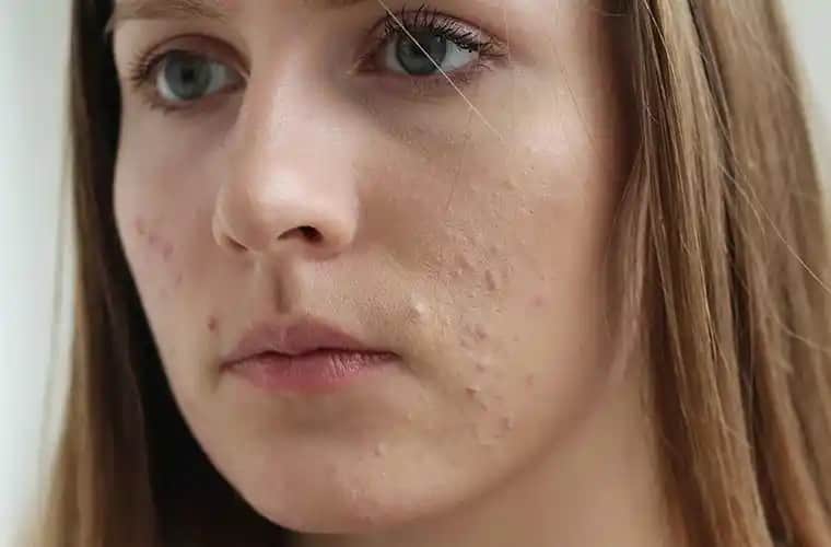 Adet Döneminde Çenede Sivilce: Nedenleri ve Etkili Çözüm Yolları