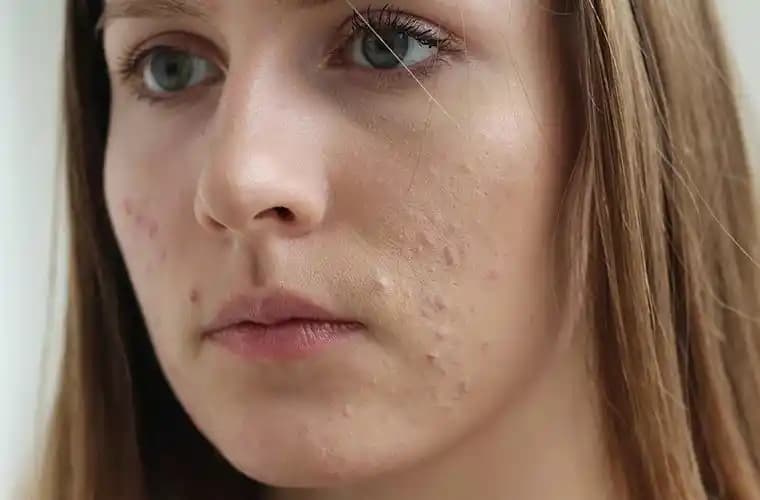 Adet Döneminde Çenede Sivilce: Nedenleri ve Etkili Çözüm Yolları