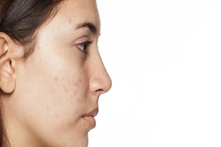 Adet Döneminde Sivilceler ve Cilt Sağlığını Koruma Yöntemleri