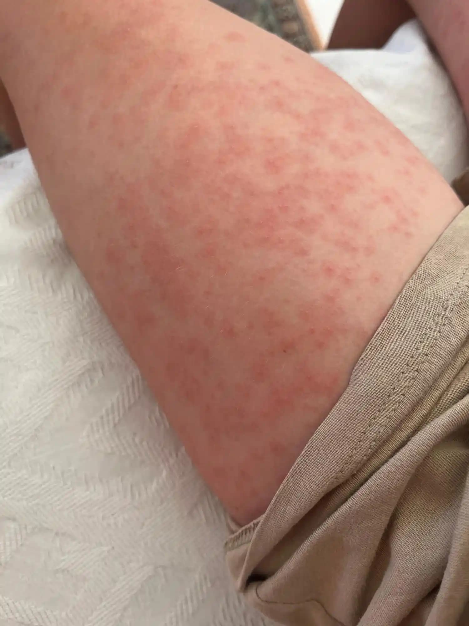 Ağda Alerjisi İçin Güvenli ve Etkili Krem Seçenekleri Rehberi