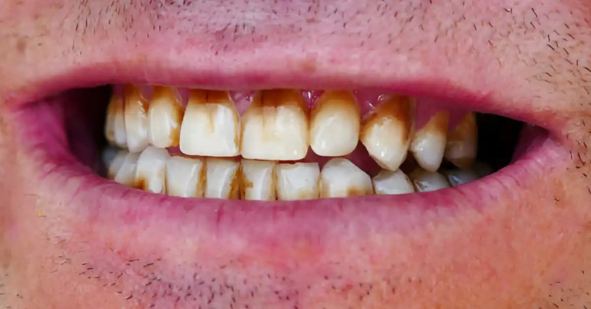 Ağız Çevresi Kararmasının Nedenleri ve Güzellik İpuçları