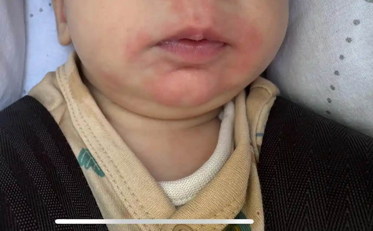 Ağız Çevresi Kızarıklığının Nedenleri, Belirtileri ve Etkili Tedavi Yöntemleri