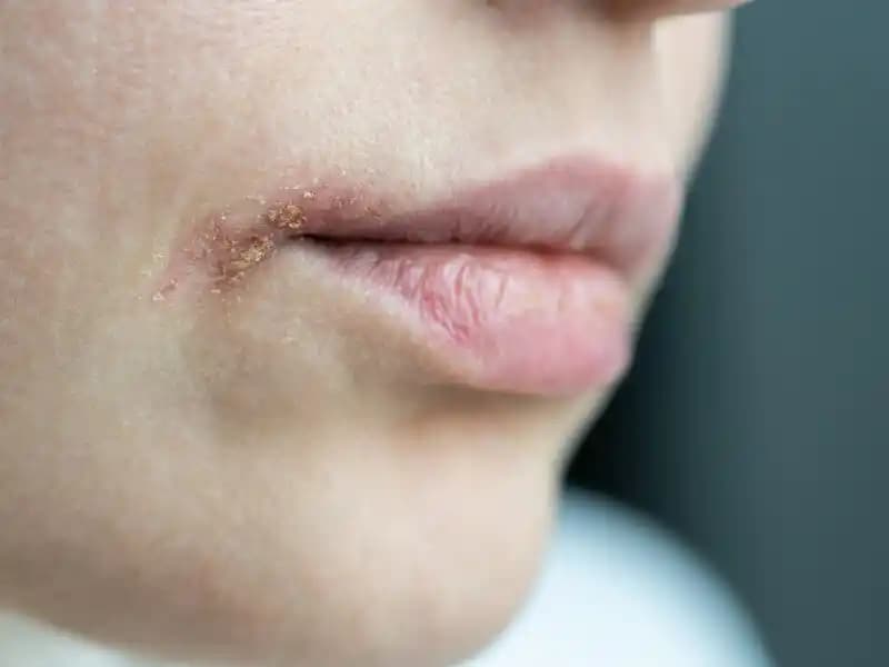 Ağız Kenarında Kuruluk ve Kızarıklık Nedenleri ve Etkili Çözüm Yöntemleri