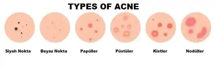Akne Türleri ve Özellikleri Hakkında Kapsamlı Bir Rehber