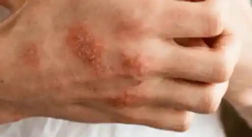 Alerjik Egzama Belirtileri ve Tanı Yöntemleri Hakkında Kapsamlı Bilgi