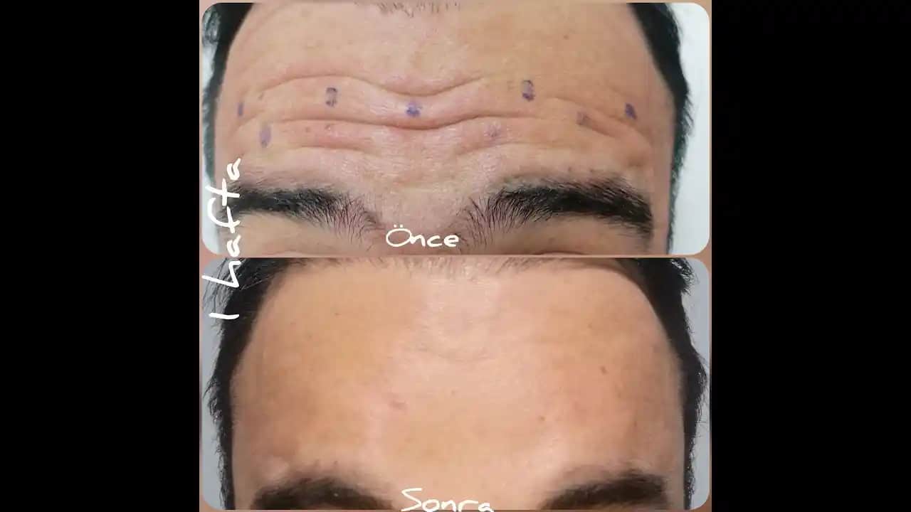 Alın Çizgileriyle Vedalaşmanın Güncel ve Etkili Kozmetik Yöntemleri