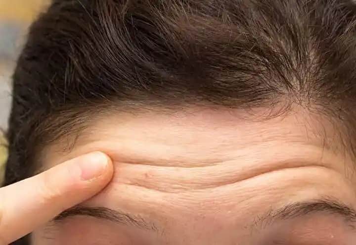 Alın Kırışıklıkları ve Güzellik ile Sağlık Arasındaki Dengeyi Sağlama Yöntemleri