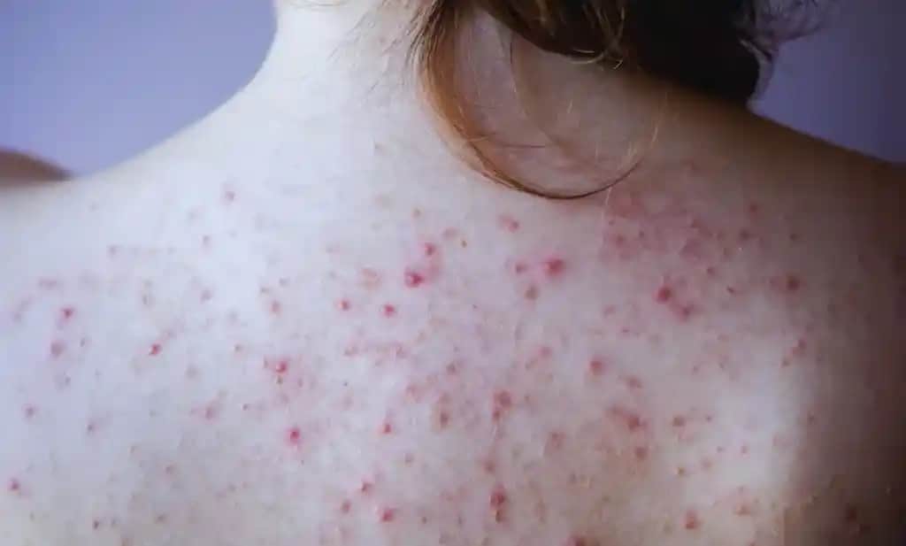 Alında Kırmızı Noktalar ve Kozmetik Yaklaşımlar: Sebepleri ve Tedavi Yöntemleri