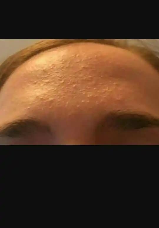 Alında Komedon Nedir, Neden Oluşur ve Etkili Korunma Yöntemleri Nelerdir