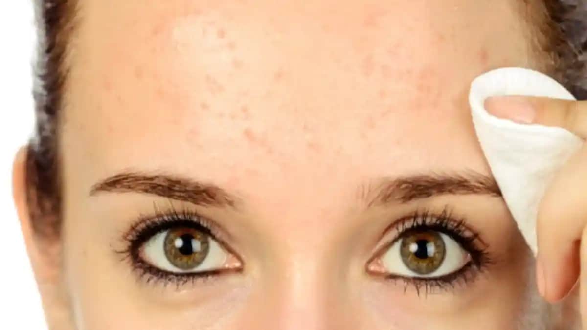 Alında Sivilce Oluşumunu Önlemenin Etkili Yolları ve Cilt Bakım İpuçları