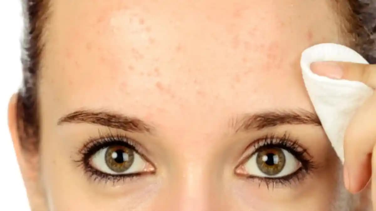 Alında Sivilce Oluşumunu Önlemenin Etkili Yolları ve Cilt Bakım İpuçları