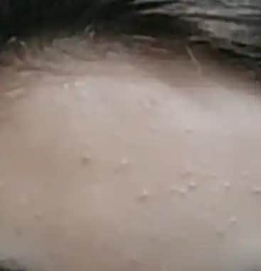 Alnınızdaki Küçük Sivilcelerin Nedenleri ve Etkili Çözüm Yöntemleri