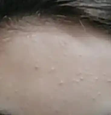 Alnınızdaki Küçük Sivilcelerin Nedenleri ve Etkili Çözüm Yöntemleri